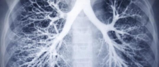 The importance of an early diagnosis in COPD patients