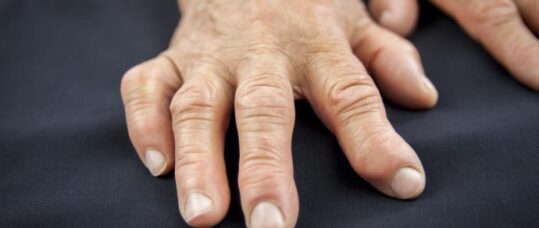 NICE issues final guidance for rheumatoid arthritis