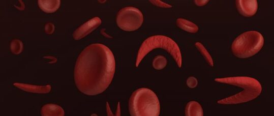 NICE recommends easier treatment for sickle cell disease