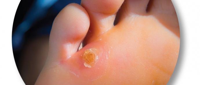 Caresource podiatry does not require referall benefits of working at centene