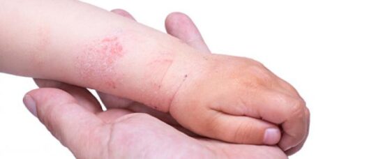 Blog: Eczema from a child and parents point of view