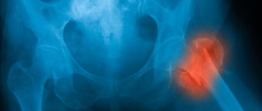 Antidepressants linked to increase risk of hip fracture in Alzheimer’s patients
