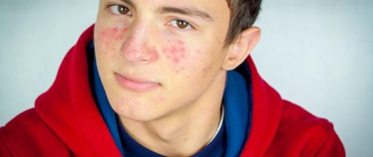 Latest treatments for acne