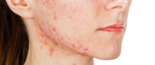 Treatments for patients with acne