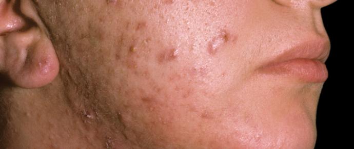 Mythbuster: 'Chocolate can cause acne, and altering the diet can ...