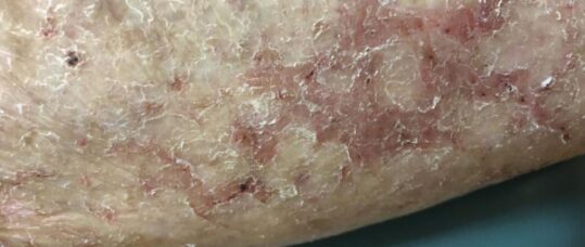 Picture quiz – dermatitis