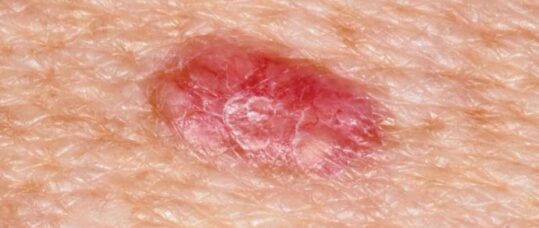 Picture quiz: skin lesions in primary care