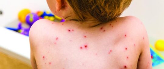 Chickenpox symptoms, treatment and vulnerable groups