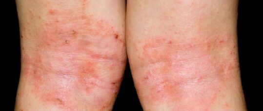 Choosing the right emollients for eczema