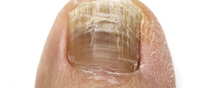 Toe Nail Fungus Types Infographic - Horizon Foot & Ankle Institute