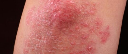 Choosing the right emollients for psoriasis