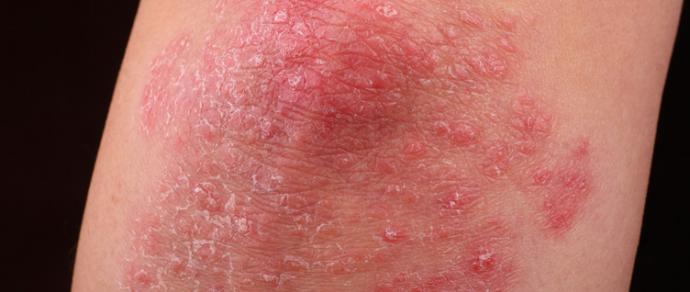 best emollient for psoriasis