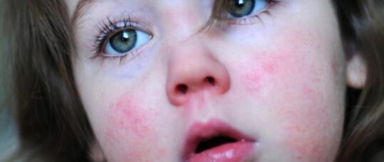 Scarlet fever cases hit 50 year peak in England