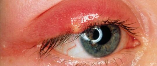 Picture quiz: Common eye presentations