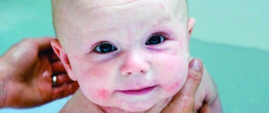 Treatment flowchart for atopic eczema in children