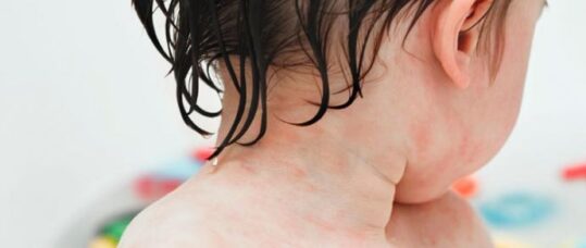 Bath emollients of no added benefit for eczema in children, study finds