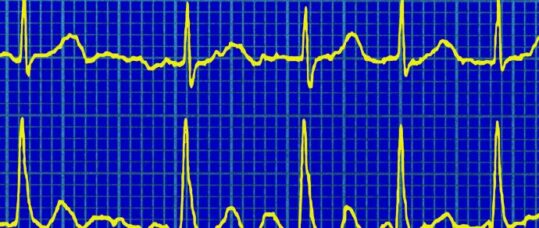 DOACs safer than warfarin for treating AF, says study