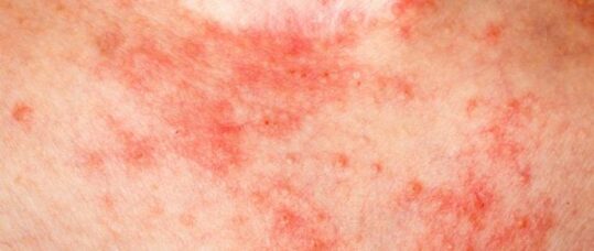 Patients with severe eczema should be screened for CV risk factors