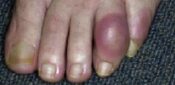 Gout patients better at sticking to treatment with nurse-led care