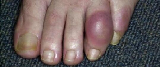 Gout patients better at sticking to treatment with nurse-led care