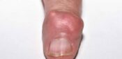 Practice nurse-led care better than GP care for treating gout