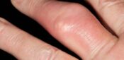 Genetics may be more important than diet in development of gout