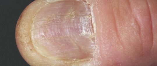 Picture quiz: nail lesions