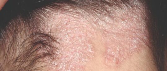 Picture quiz: scalp conditions