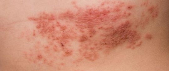 Shingles cases reduced by a third due to vaccine
