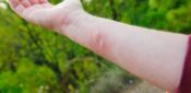 Insect sting allergy – key facts for a Practice Nurse