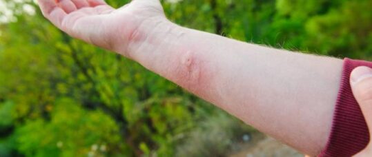 Insect sting allergy – key facts for a Practice Nurse