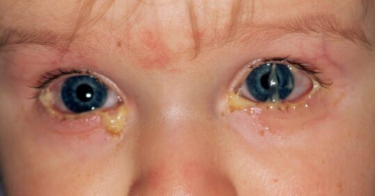 CPD module: Conjunctivitis