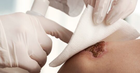 Genetics may influence wound healing