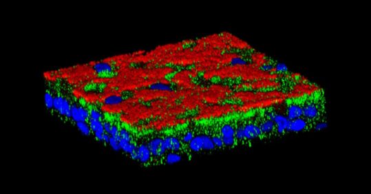 Study reveals cause of respiratory infections in cystic fibrosis