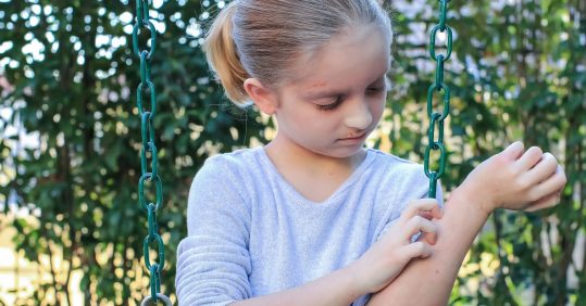 ‘Minimally invasive’ tape strips tell eczema from psoriasis