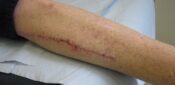 In review: How to do a comprehensive wound assessment