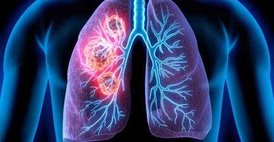 Targeted drugs could be contributing to sharp decline in deaths from most common lung cancer