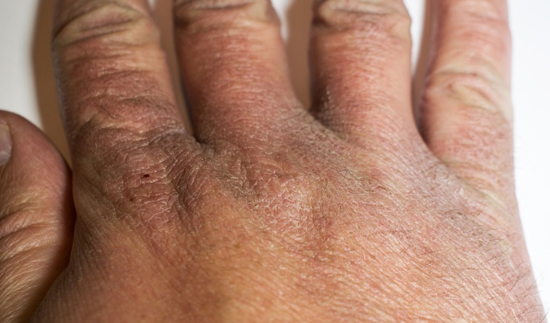 Spotting The Signs Of Covid 19 Related Skin Conditions Nursing In Practicenursing In Practice