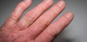 Psoriatic arthritis likely to have common trigger