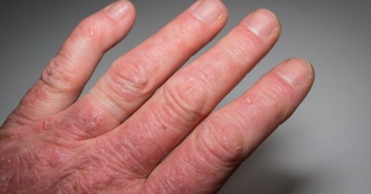 Psoriatic arthritis likely to have common trigger