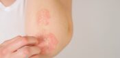 Eczema ‘significantly reduces’ quality of life for most sufferers