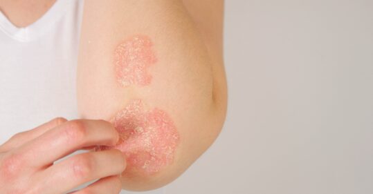 Eczema ‘significantly reduces’ quality of life for most sufferers