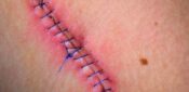 Learning module: managing surgical wounds after an operation