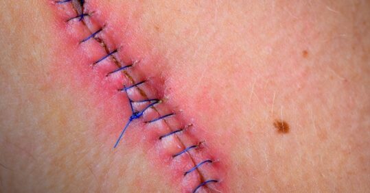 Learning module: managing surgical wounds after an operation