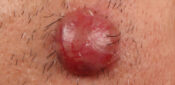 Picture quiz – skin lesions and how to refer them