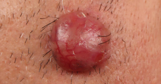 Picture quiz – skin lesions and how to refer them