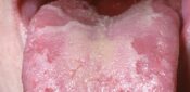 Picture quiz – tongue conditions and how to treatment them