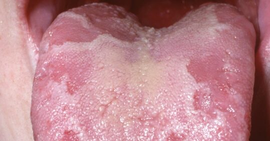 Picture quiz – tongue conditions and how to treatment them