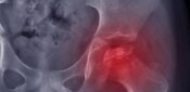 Understanding a painful, little-known condition in children: Perthes disease