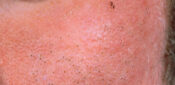 Picture quiz – types of acne
